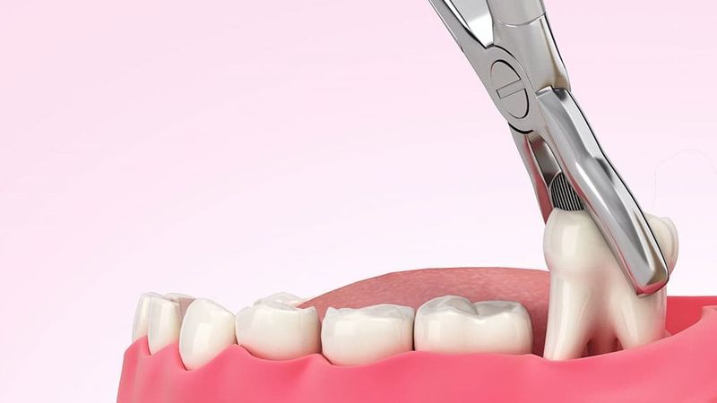 Nhổ răng khôn tại nha khoa phường Trung Mỹ Tây