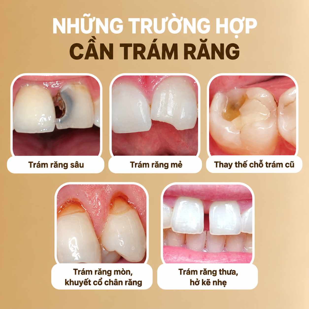 Trám răng tại nha khoa gần đường Huỳnh Thị Hai