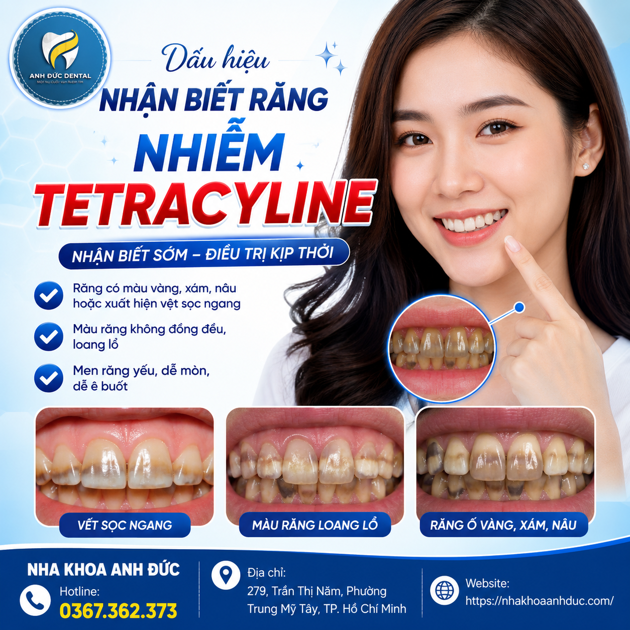 Dấu hiệu nhận biết răng nhiễm Tetracycline