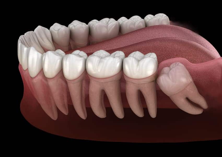 Tại sao nên nhổ răng không mọc lệch 45 độ?