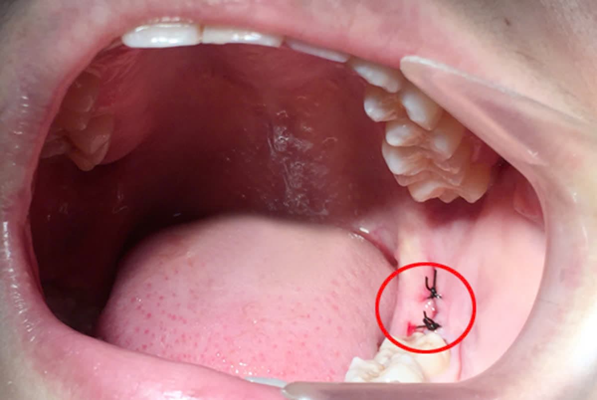 Quy trình nhổ răng khôn gần đường Nguyễn Ảnh Thủ chuẩn y khoa tại Nha khoa Anh Đức