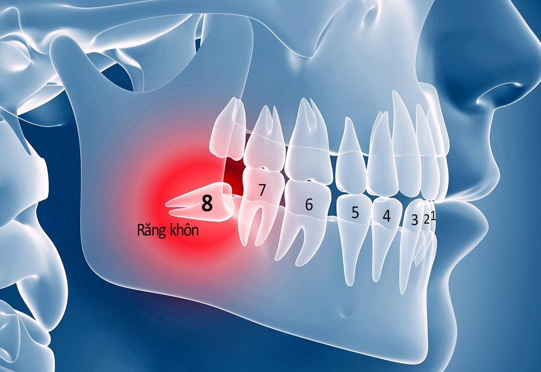Nhổ răng khôn tại nha khoa phường Trung Mỹ Tây