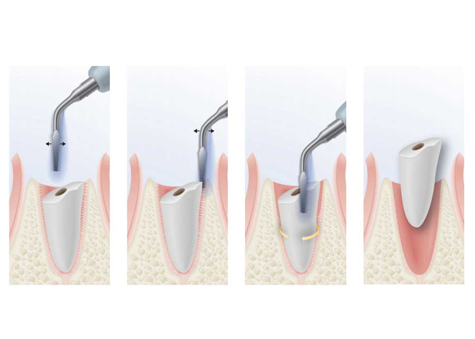 Địa chỉ nhổ răng khôn gần đường Nguyễn Ảnh Thủ