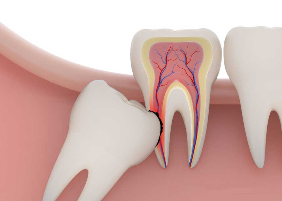 Địa chỉ nhổ răng khôn gần đường Nguyễn Ảnh Thủ