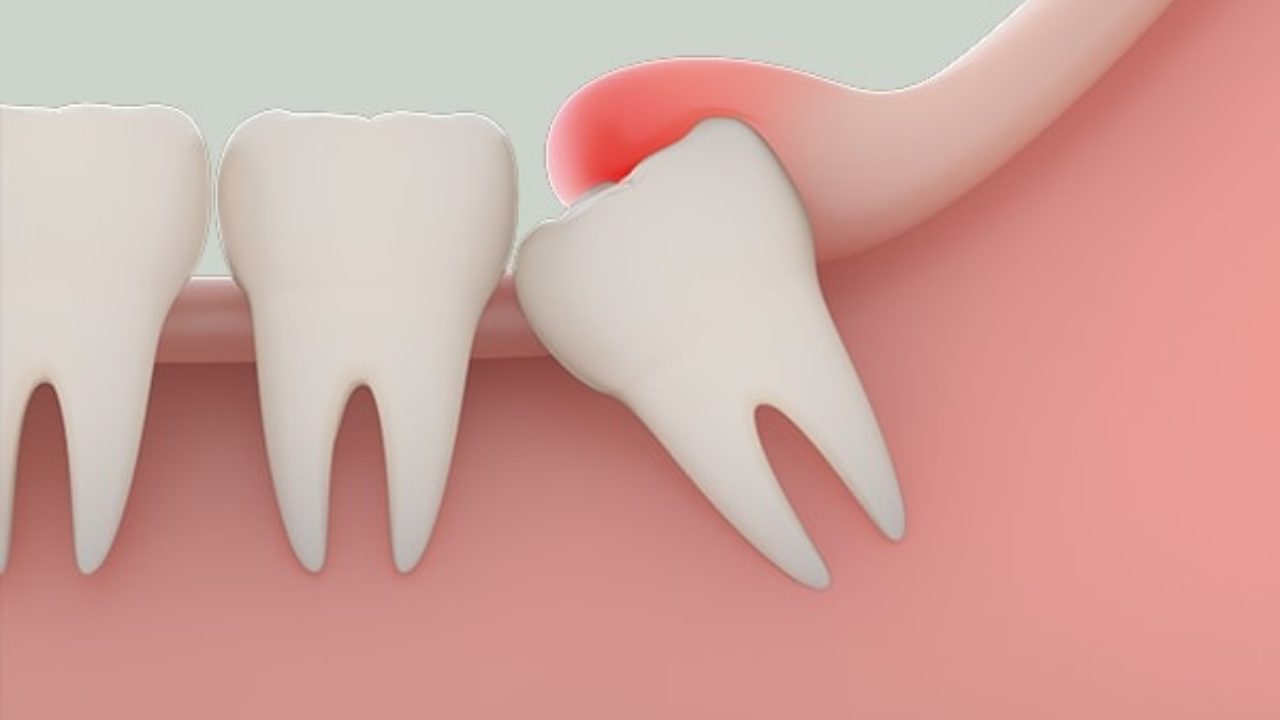 Tại sao nên nhổ răng không mọc lệch 45 độ?