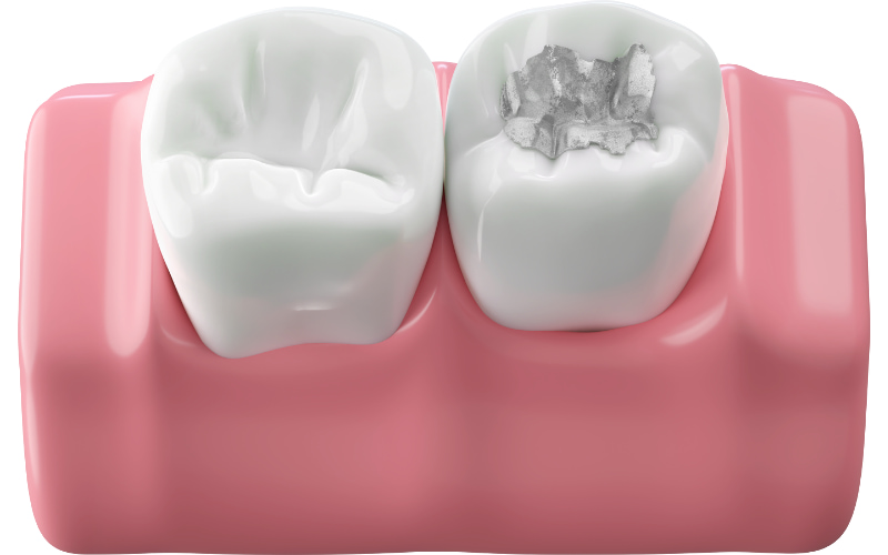 Trám răng tại nha khoa gần đường Huỳnh Thị Hai