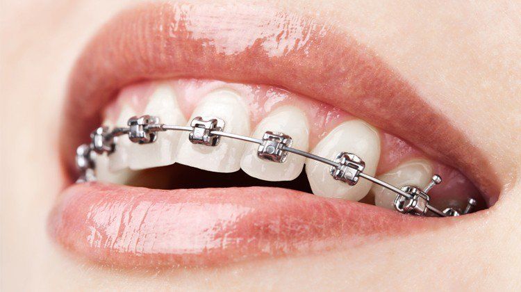 Niềng răng mắc cài kim loại thường