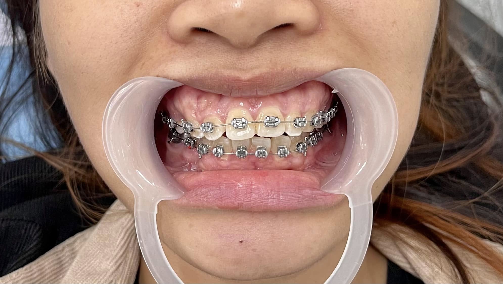 Những trường hợp nên niềng răng mắc cài kim loại