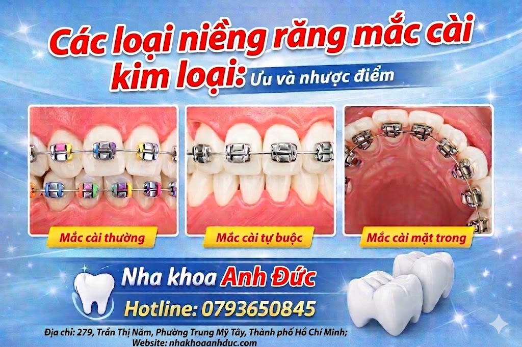Các loại niềng răng mắc cài kim loại: Ưu và nhược điểm