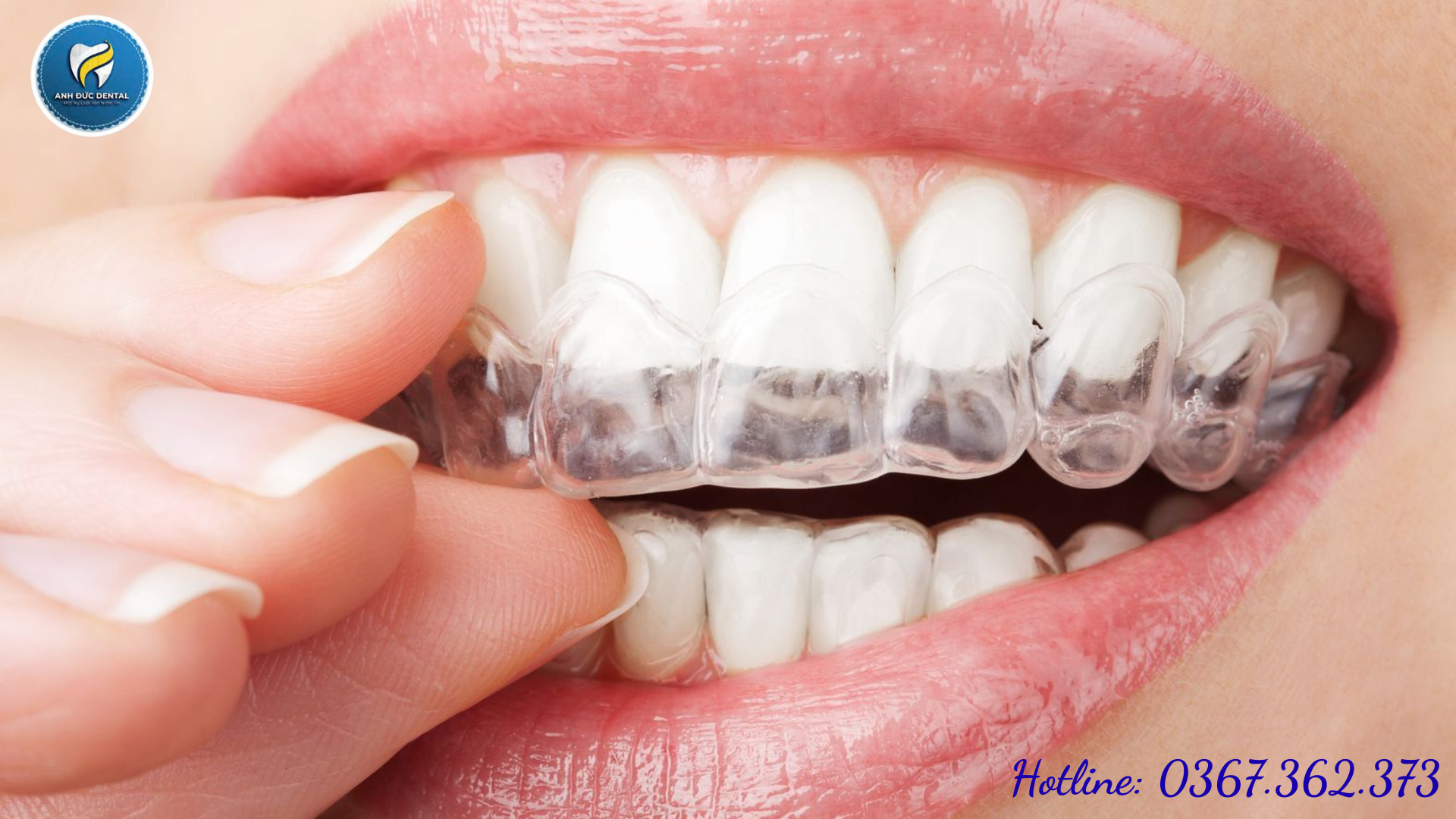 Niềng răng tại nha khoa gần đường Huỳnh Thị Hai