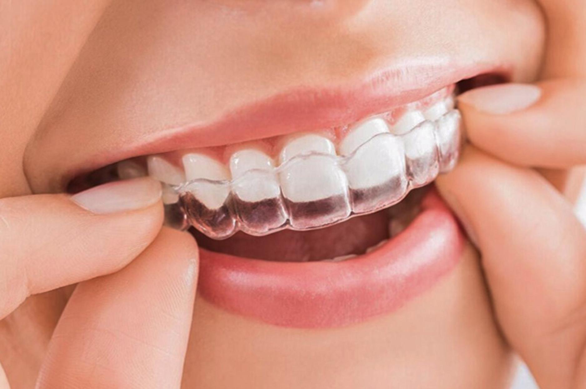 Dịch vụ niềng răng uy tín tại nha khoa quận 12