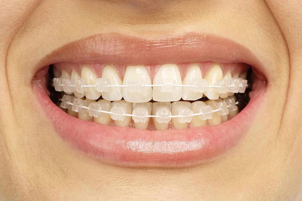 Dịch vụ niềng răng uy tín tại nha khoa quận 12