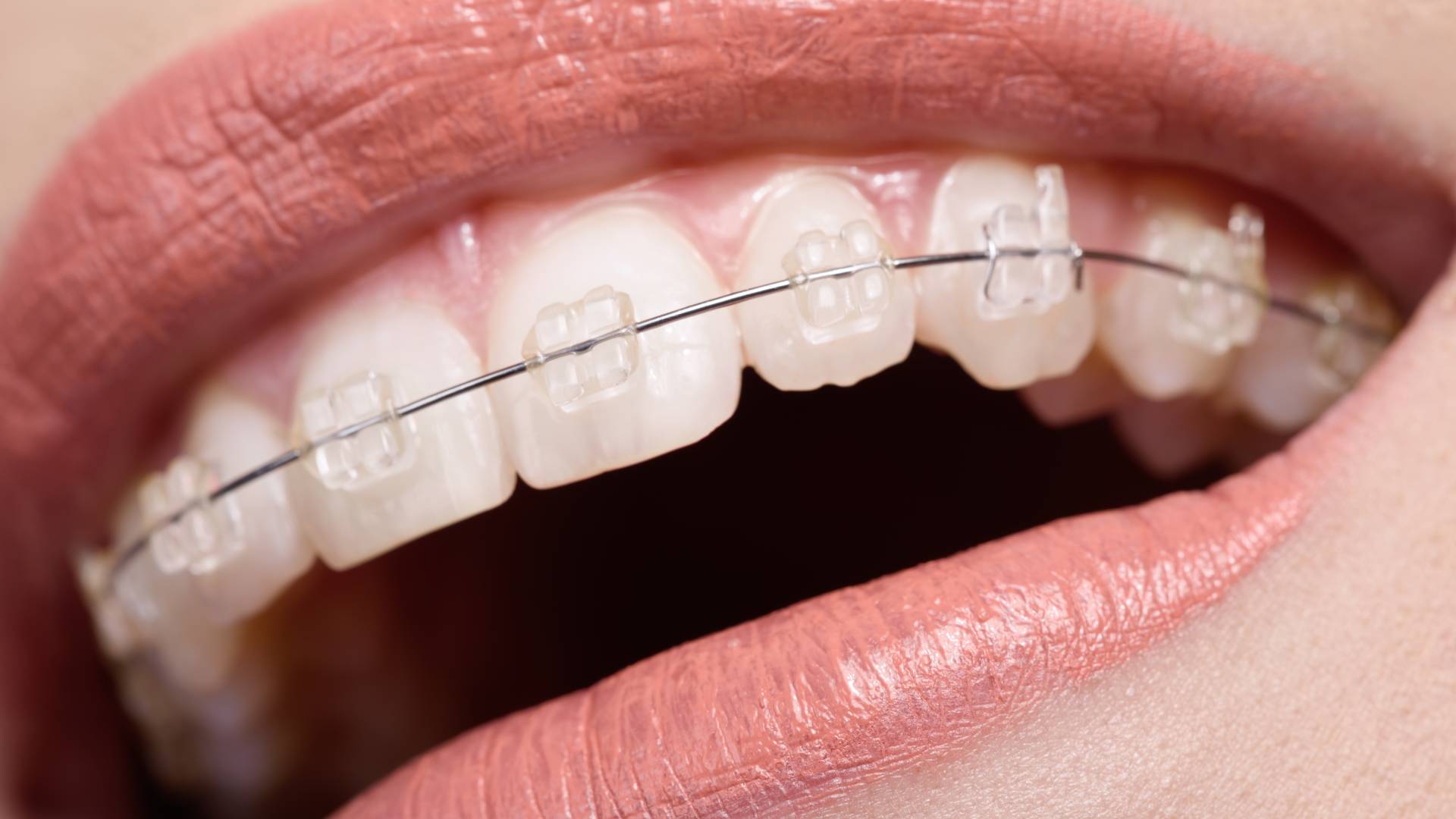 Niềng răng tại nha khoa gần đường Huỳnh Thị Hai