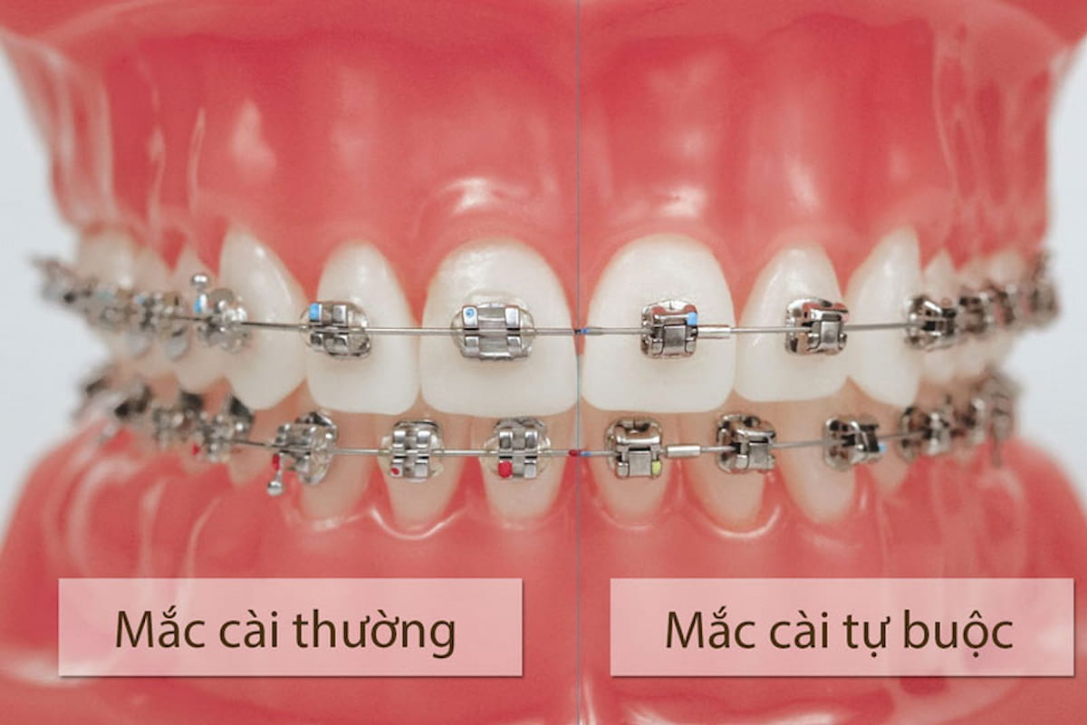 Dịch vụ niềng răng uy tín tại nha khoa quận 12