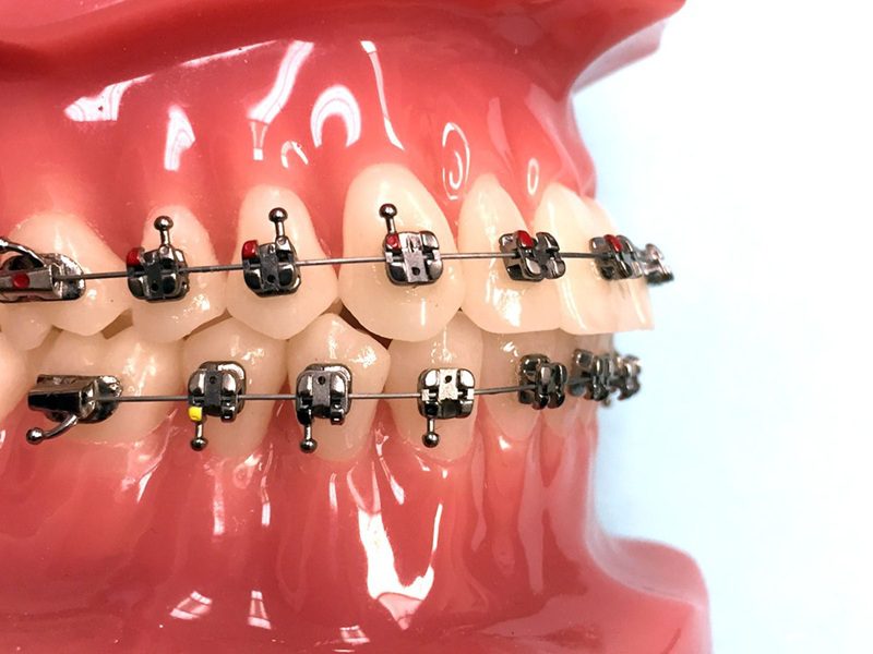 Niềng răng mắc cài tự buộc