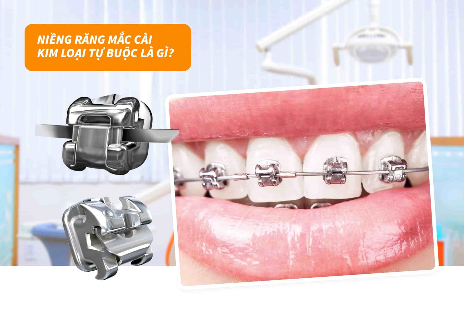 Niềng răng mắc cài kim loại tự buộc