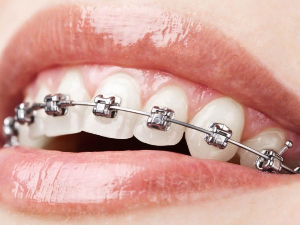Khám phá công nghệ tiên tiến của mắc cài kim loại tự buộc