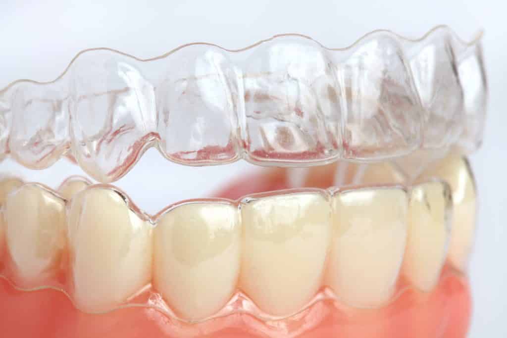 Niềng răng trong suốt (Invisalign)
