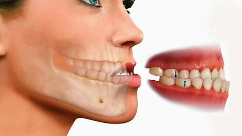 Hình ảnh về tình trạng răng móm