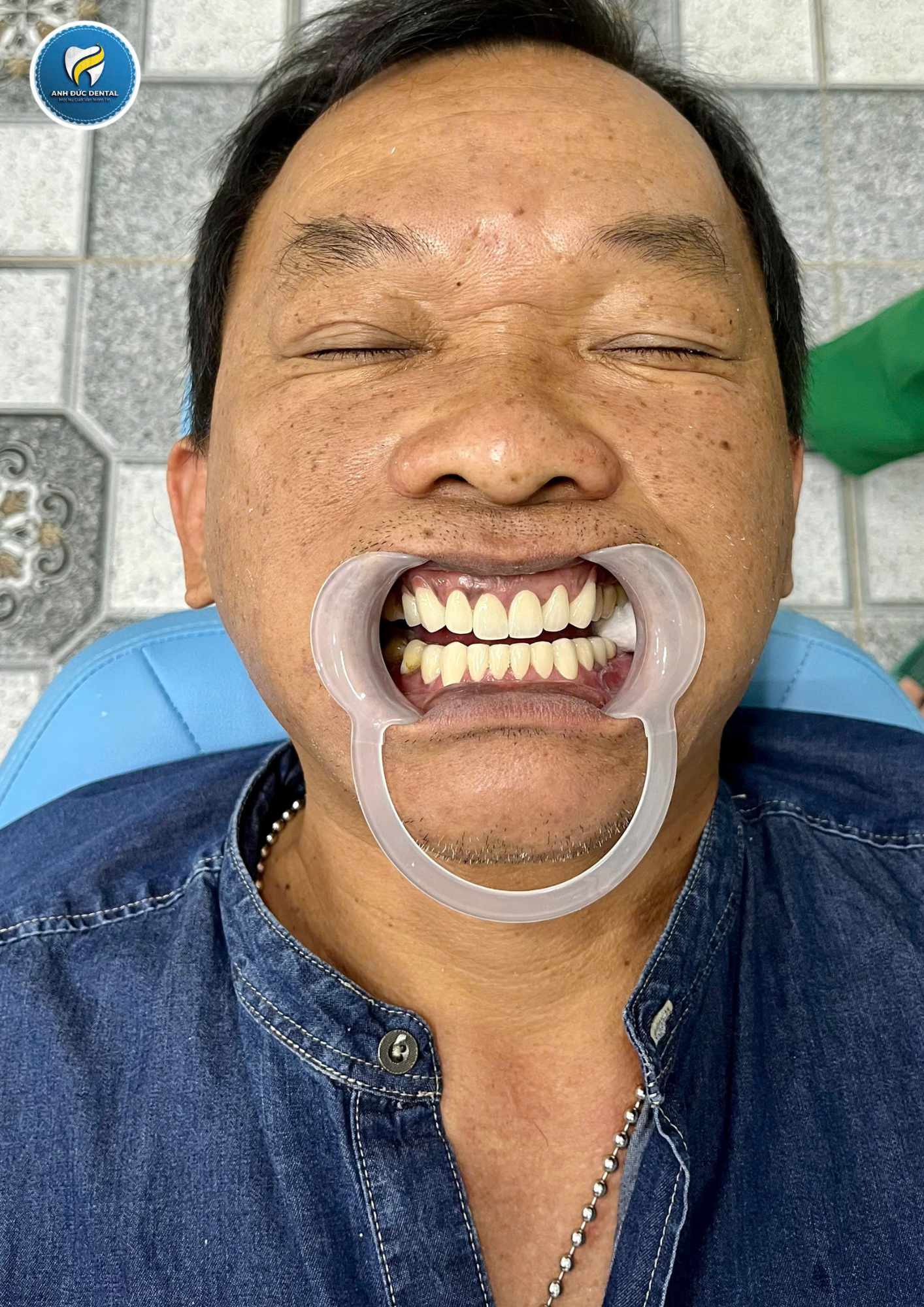 Hình ảnh răng khách hàng sau khi làm răng tại Nha khoa Anh Đức