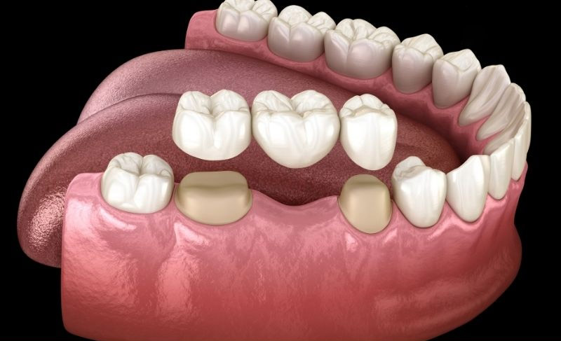 Phương pháp làm cầu răng sứ – Phục hồi thẩm mỹ nhanh chóng