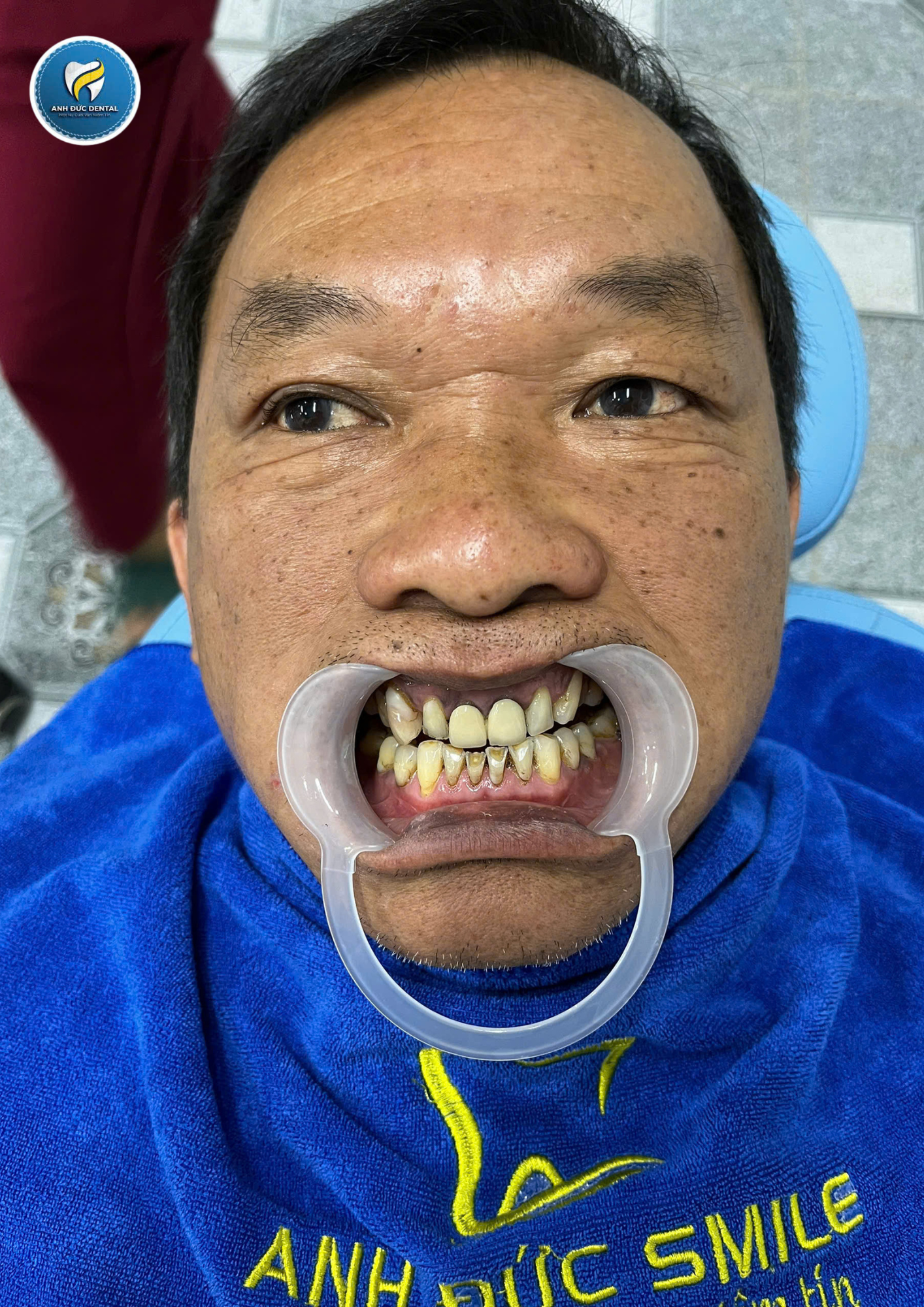 Hình ảnh răng khách hàng trước khi làm răng tại Nha khoa Anh Đức