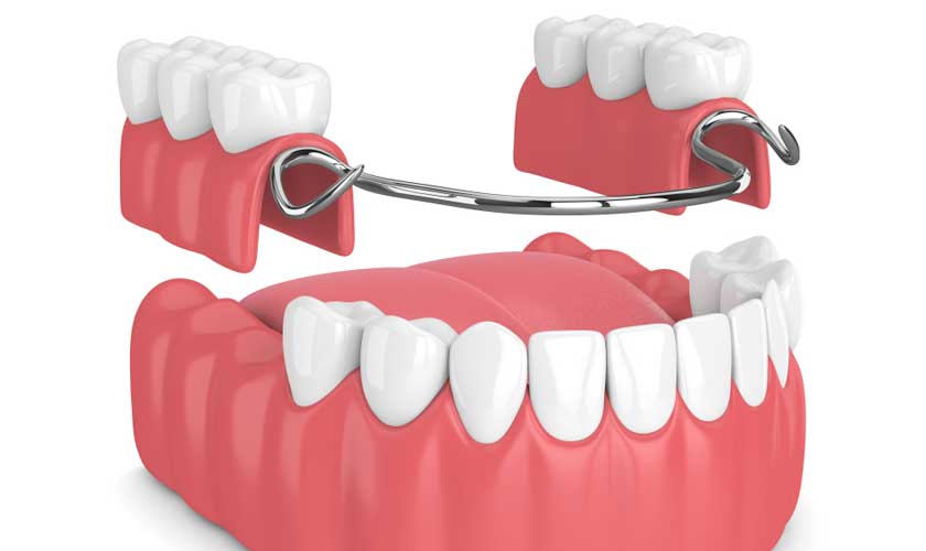 Hàm giả tháo lắp kết hợp attachment (khóa cài)