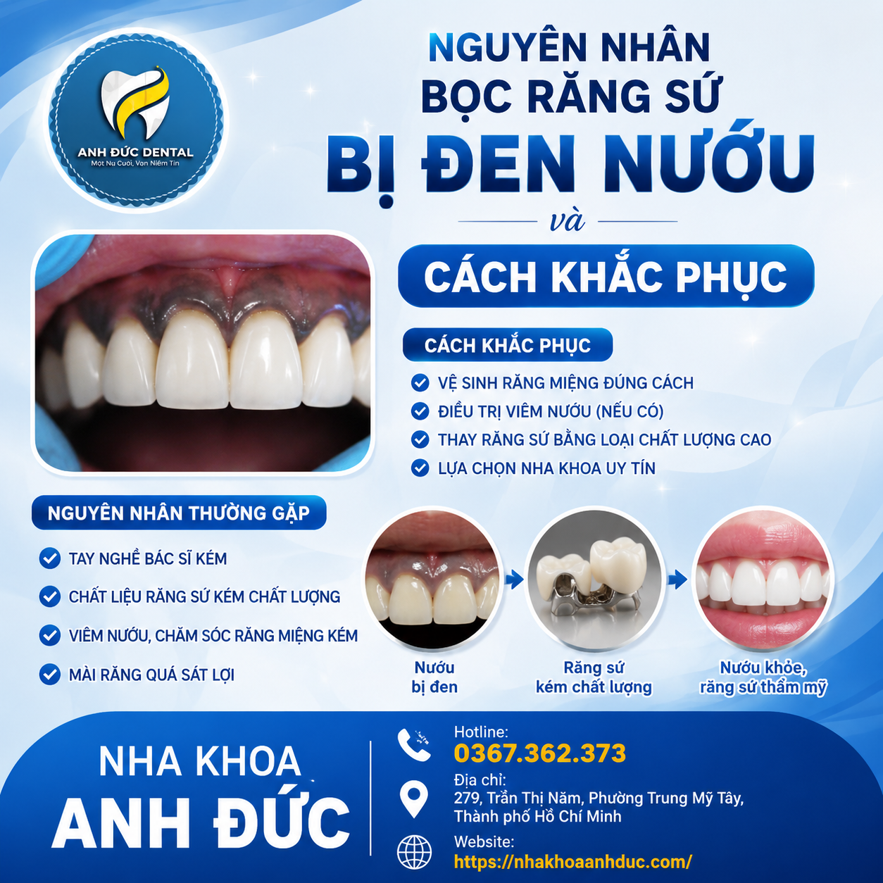 Nguyên nhân bọc răng sứ bị đen nướu và cách khắc phục