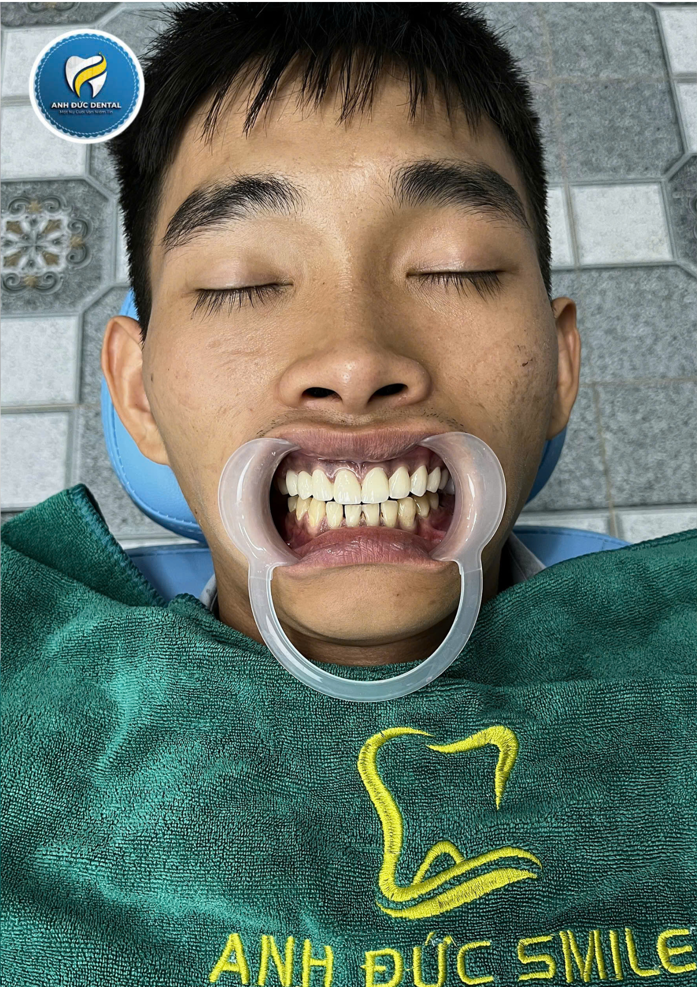 Nguyên nhân bọc răng sứ bị đen nướu và cách khắc phục