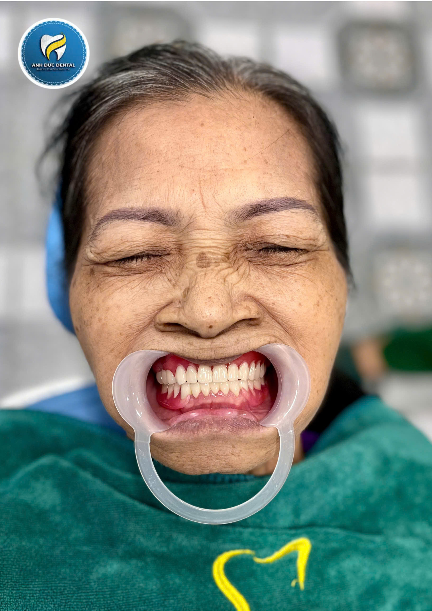 Tìm hiểu về răng tháo lắp composite: Ưu và nhược điểm