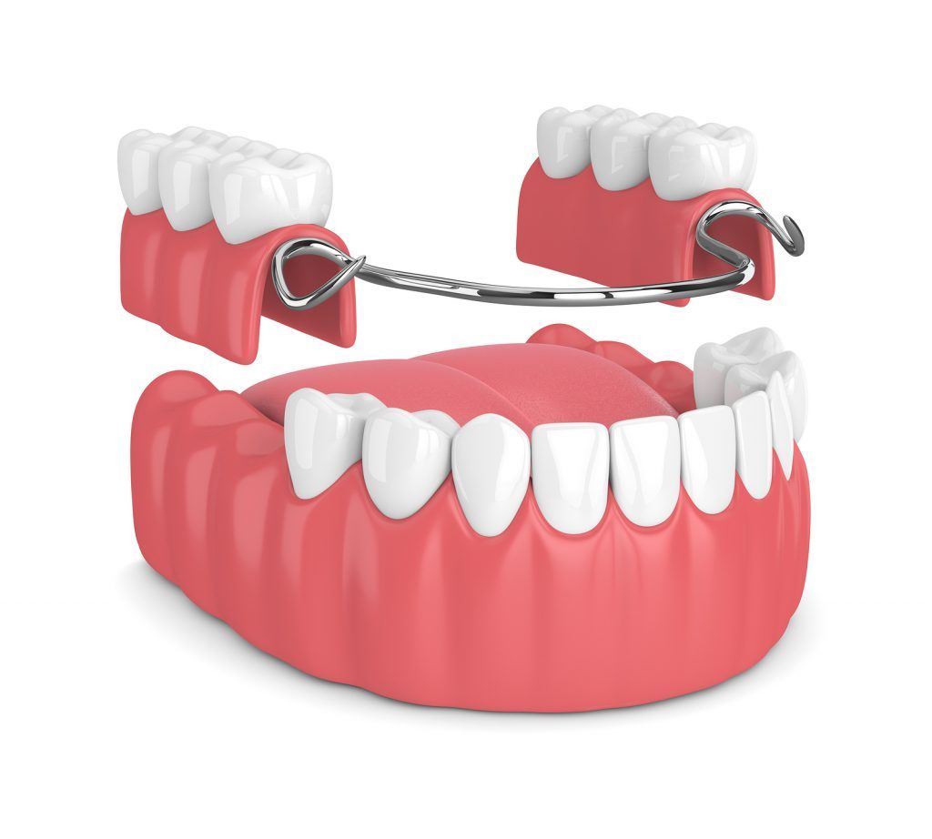 Tìm hiểu về răng tháo lắp composite: Ưu và nhược điểm