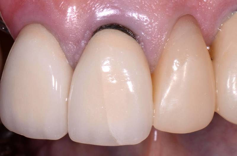 Nguyên nhân bọc răng sứ bị đen nướu và cách khắc phục