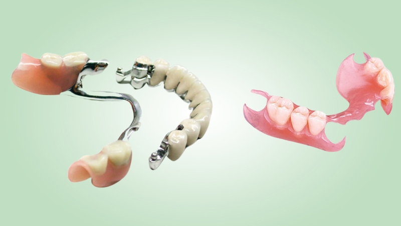 Tìm hiểu về răng tháo lắp composite: Ưu và nhược điểm