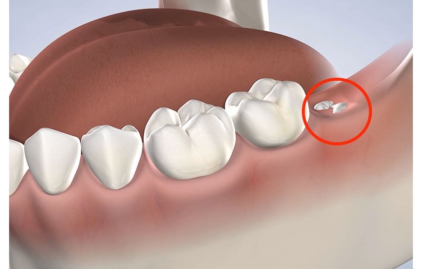 Nha khoa Anh Đức – Địa chỉ nhổ răng khôn gần đường Nguyễn Ảnh Thủ uy tín chất lượng