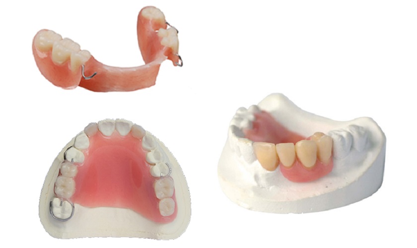Phục hình tháo lắp tại Nha khoa quận 12