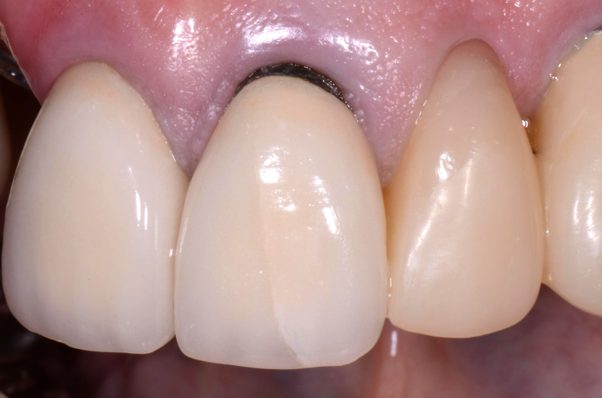Nguyên nhân bọc răng sứ bị đen nướu và cách khắc phục