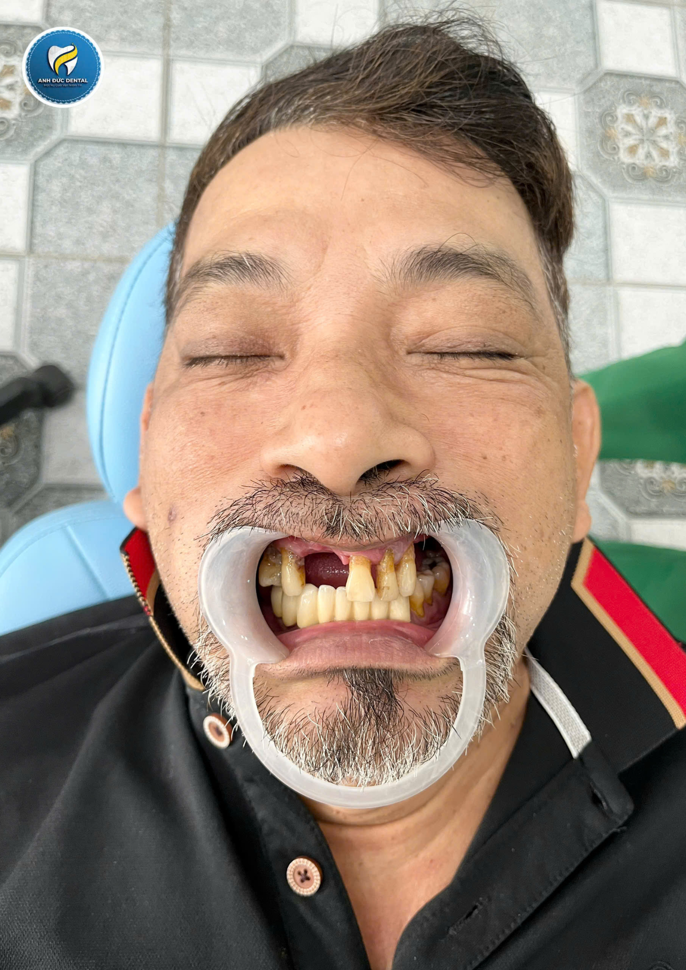 Trồng răng cho người cao tuổi tại phường Trung Mỹ Tây