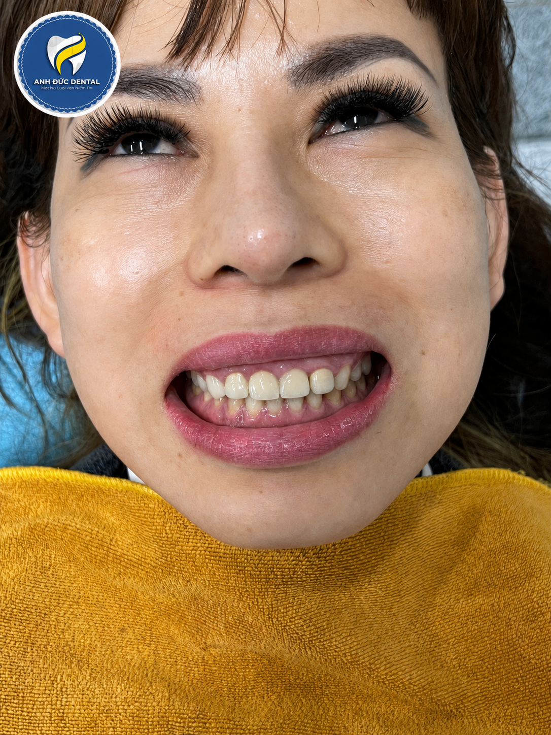 Bọc răng sứ gần đường Lê Văn Khương an toàn, thẩm mỹ