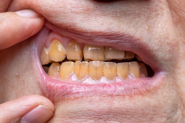 Dấu hiệu nhận biết răng nhiễm Tetracycline