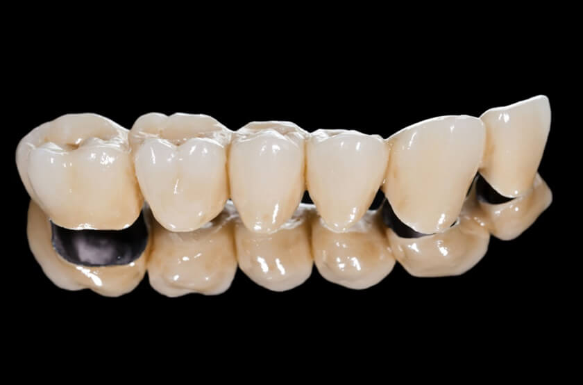 Hình ảnh về răng sứ Titan