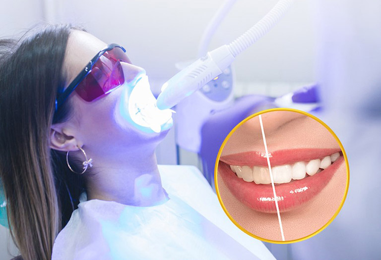 Quy trình tẩy trắng răng tại Nha khoa Anh Đức quận 12