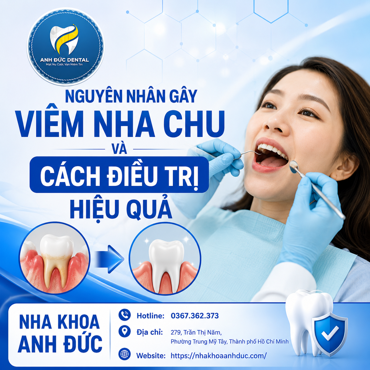 Nguyên nhân gây viêm nha chu và cách điều trị hiệu quả