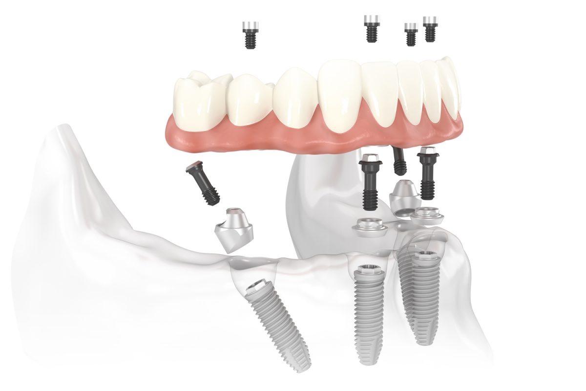 Quy trình Trồng răng Implant All-on-4 tại Nha khoa quận 12 Anh Đức