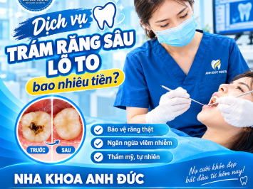 Dịch vụ trám răng sâu lỗ to bao nhiêu tiền?