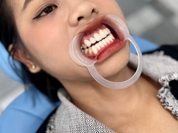 Bọc răng sứ bao nhiêu tiền quận 12