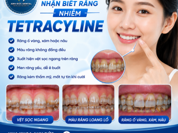 Dấu hiệu nhận biết răng nhiễm Tetracyline