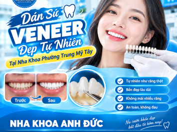 Dán sứ Veneer đẹp tự nhiên tại nha khoa phường Trung Mỹ Tây