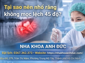 Tại sao nên nhổ răng không mọc lệch 45 độ?