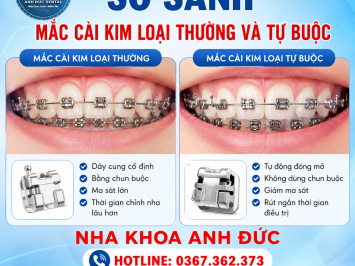 So sánh mắc cài kim loại thường và tự buộc
