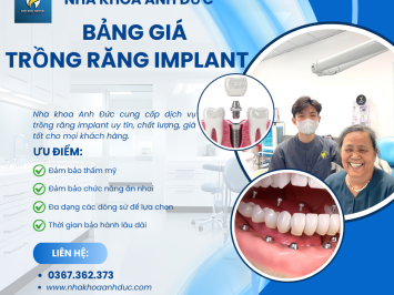 Bảng giá trồng răng Implant 